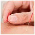 inserting acupuncture needles